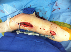 In Vivo Investigations of Bone Plates: A Review study